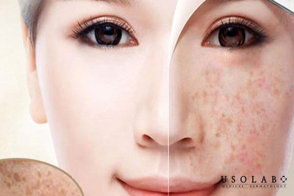 Tàn nhang (freckles/ephelides) là những đốm nâu–vàng nhạt, kích thước nhỏ (thường 1–5 mm)
