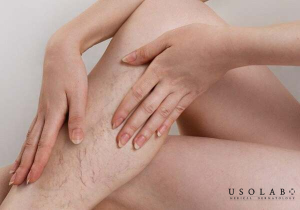 Da nhiều tế bào chết, không mịn màng khiến kem khó thấm