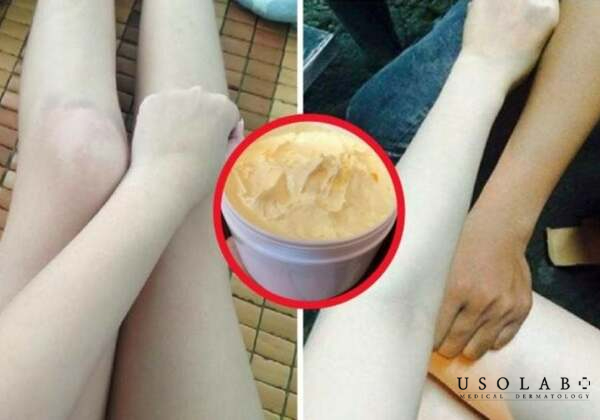 Thoa kem khi da bé còn ẩm