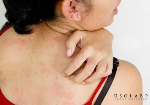 Sử dụng không đúng cách có thể gây ra những tổn về da