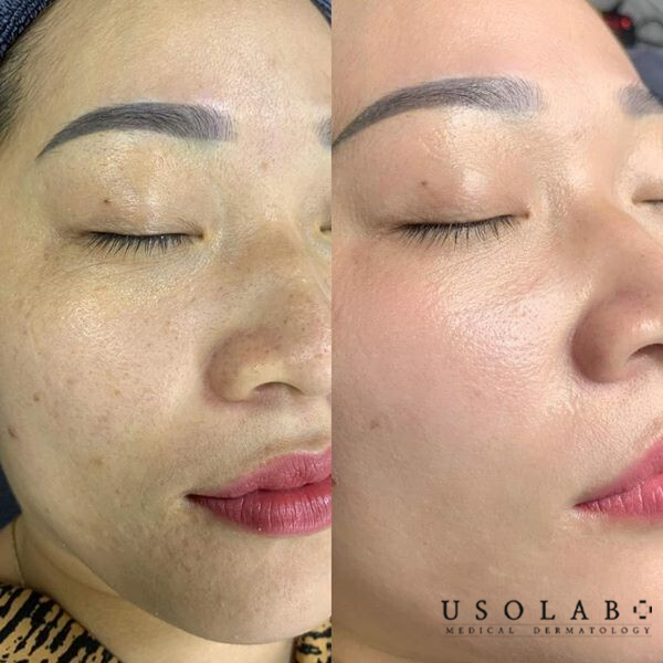 Cấy trắng collagen được đánh giá là có đem lại hiệu quả khá rõ rệt Cấy trắng collagen được đánh giá là có đem lại hiệu quả khá rõ rệt