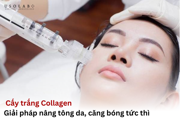 cấy trắng collagen