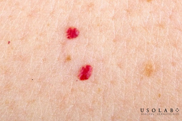 Cách phân biệt nốt đỏ lành tính và bất thường