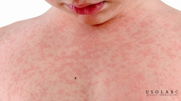 Phòng ngừa tình trạng nổi chấm đỏ trên da