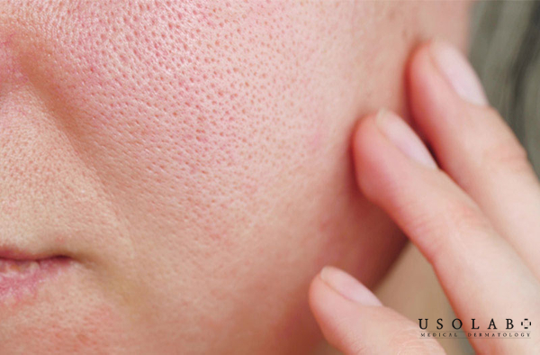 Da bị tổn thương nếu không được phục hồi đúng cách sẽ dễ trở nên yếu, nhạy cảm Da bị tổn thương nếu không được phục hồi đúng cách sẽ dễ trở nên yếu, nhạy cảm