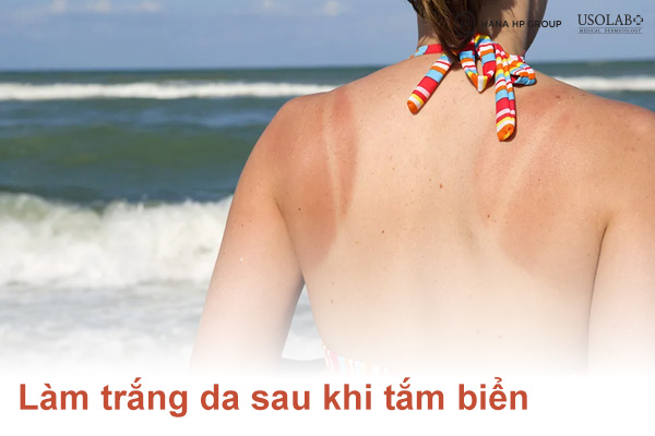 11 Cách làm trắng da sau khi tắm biển hiệu quả và an toàn tại nhà