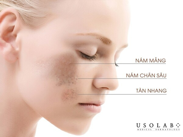Tia UVA, UVB gây hại đến hàng rào bảo vệ da gây sạm, ám
