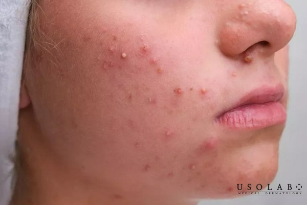 Da mẩn đỏ, nổi mụn li ti là một trong những dấu hiệu rõ ràng nhất