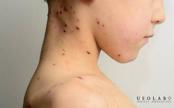 Sẹo thủy đậu là hậu quả để lại sau khi các nốt mụn nước do bệnh thủy đậu Sẹo thủy đậu là hậu quả để lại sau khi các nốt mụn nước do bệnh thủy đậu