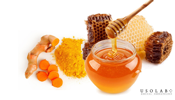 Công thức trị sẹo thủy đậu bằng nghệ tươi và mật ong Công thức trị sẹo thủy đậu bằng nghệ tươi và mật ong