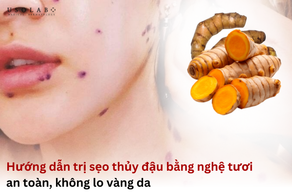 trị sẹo thủy đậu bằng nghệ tươi