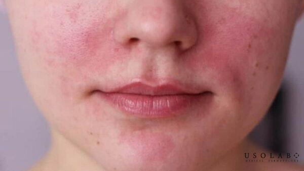 Da đang bị mụn viêm, mụn mủ hoặc mụn bọc và vừa nặn mụn hoặc peel da