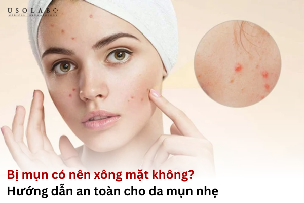 bị mụn có nên xông mặt không