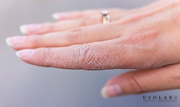 Da tay là vùng tiếp xúc môi trường nhiều nhất nên rất dễ bị khô Da tay là vùng tiếp xúc môi trường nhiều nhất nên rất dễ bị khô