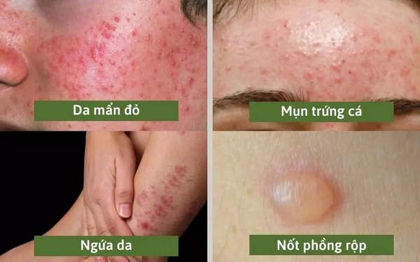 Da bị kích ứng là gì và nguyên nhân thường gặp Da bị kích ứng là gì và nguyên nhân thường gặp