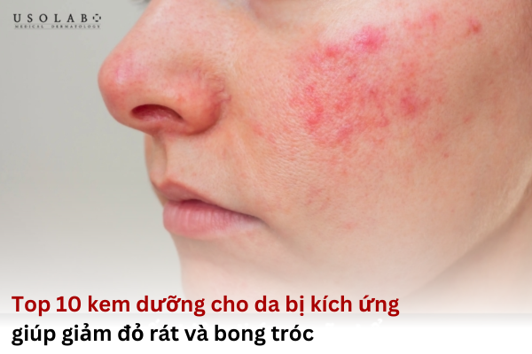 kem dưỡng cho da bị kích ứng