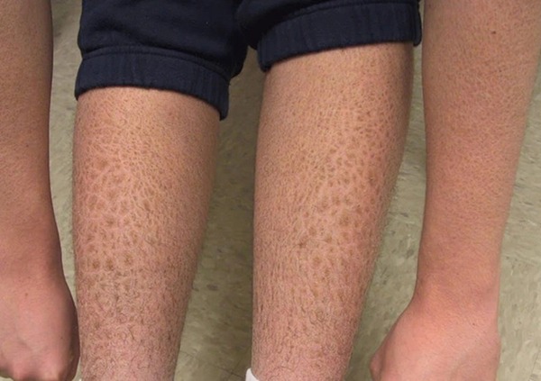 Vì da chân chịu nhiều áp lực từ việc đi lại, ma sát và tiếp xúc với môi trường bên ngoài