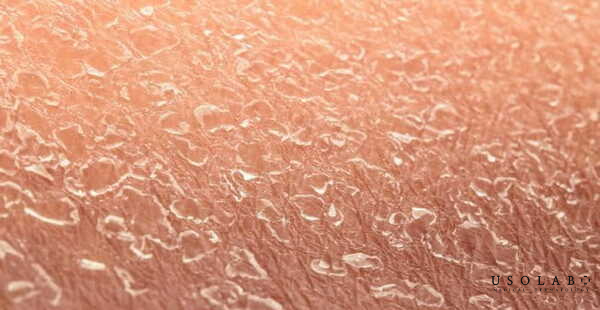 Là do thiếu độ ẩm khi da mất nước quá nhiều, đặc biệt trong thời tiết hanh khô