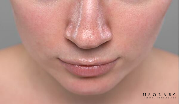 Da dầu có cần kem dưỡng ẩm không?