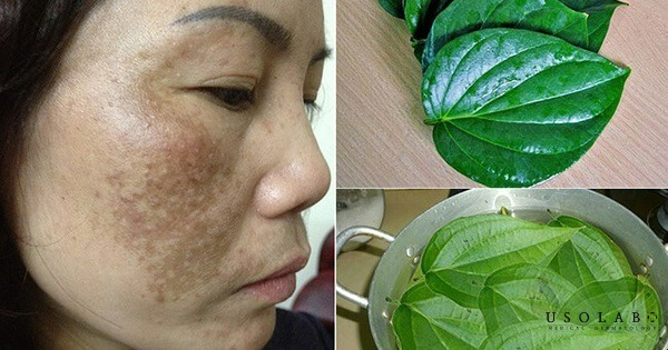 Ưu điểm và hạn chế của việc xông mặt bằng lá trầu không