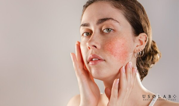 Da khô, thiếu ẩm, da nhạy cảm, da bị tổn thương hoặc vừa điều trị mụn Da khô, thiếu ẩm, da nhạy cảm, da bị tổn thương hoặc vừa điều trị mụn