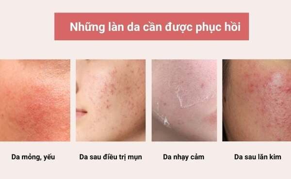 Bao lâu thì da mỏng yếu phục hồi khi dùng serum