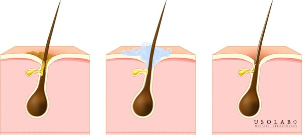 Làm sạch sâu và thông thoáng lỗ chân lông, kháng khuẩn, giảm viêm mụn