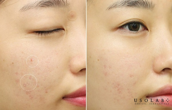 Da sạch sâu, giảm mụn rõ rệt, làn da mềm mại, ẩm mượt