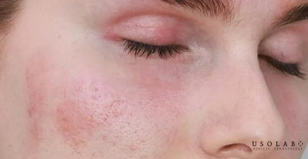 Ai nên và không nên xông mặt bằng vitamin E?