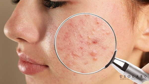 Mụn ẩn là loại mụn nằm sâu dưới bề mặt da, không viêm, không có đầu nhân trồi lên Mụn ẩn là loại mụn nằm sâu dưới bề mặt da, không viêm, không có đầu nhân trồi lên