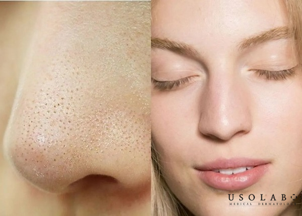 Review xông mặt trị mụn ẩn Review xông mặt trị mụn ẩn