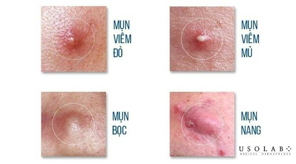 Ai nên và không nên áp dụng xông mặt trị mụn ẩn? Ai nên và không nên áp dụng xông mặt trị mụn ẩn?