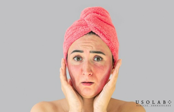 Những sai lầm khiến xông mặt trị mụn không hiệu quả