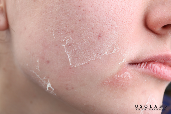 Betaine có an toàn không? Ai nên dùng?