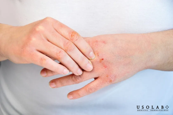 Khô da tay chân suy giảm hàng rào bảo vệ da do thời tiết lạnh, độ ẩm không khí thấp Khô da tay chân suy giảm hàng rào bảo vệ da do thời tiết lạnh, độ ẩm không khí thấp