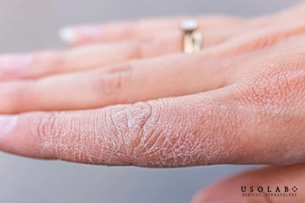 Nguyên nhân khiến da tay chân khô ráp và bong tróc khi trời lạnh Nguyên nhân khiến da tay chân khô ráp và bong tróc khi trời lạnh