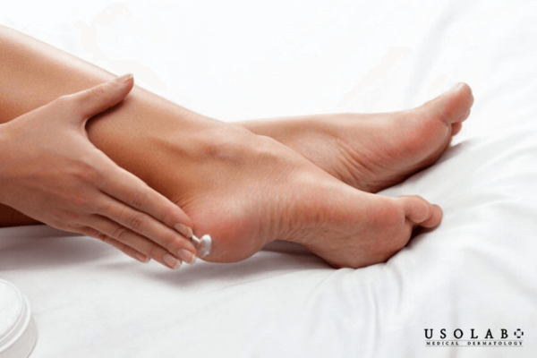 Da tay chân khô nứt mùa đông có nên tẩy tế bào chết Da tay chân khô nứt mùa đông có nên tẩy tế bào chết