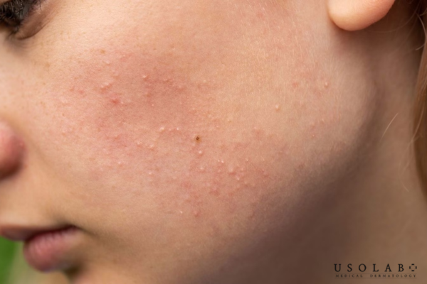 Mụn ẩn không nên tự ý nặn vì nhân mụn nằm sâu dưới da Mụn ẩn không nên tự ý nặn vì nhân mụn nằm sâu dưới da