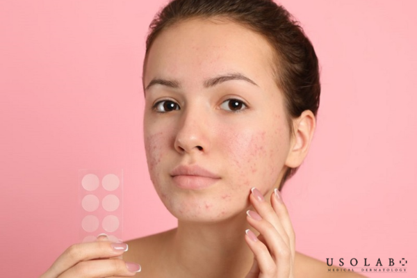 Sai lầm thường gặp khi xử lý mụn ẩn Sai lầm thường gặp khi xử lý mụn ẩn