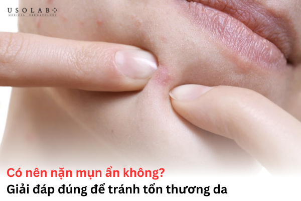 có nên nặn mụn ẩn không