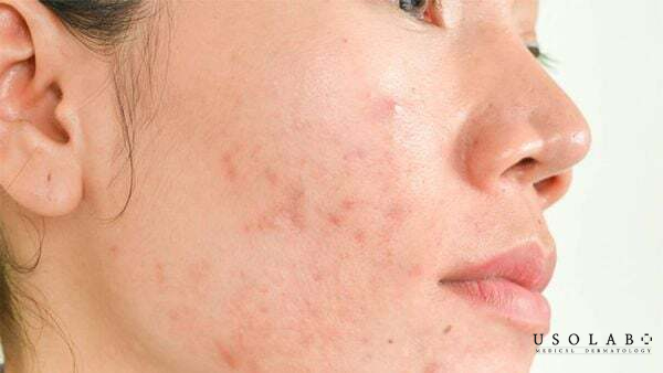 Da tiếp xúc nhiều hóa chất, mỹ phẩm không phù hợp Da tiếp xúc nhiều hóa chất, mỹ phẩm không phù hợp