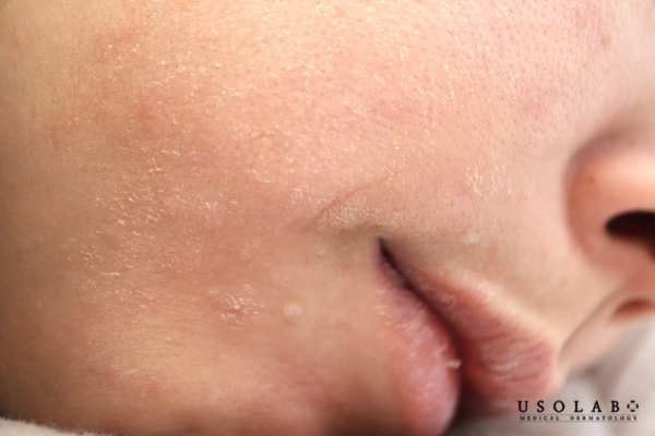 Là tình trạng da bị mất nước và suy yếu hàng rào bảo vệ do độ ẩm không khí giảm Là tình trạng da bị mất nước và suy yếu hàng rào bảo vệ do độ ẩm không khí giảm