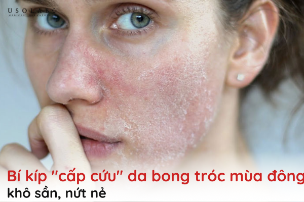 da bong tróc mùa đông