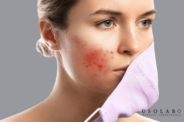 Nguyên nhân khiến da bị break out