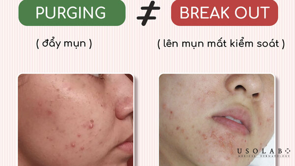 Dấu hiệu giúp nhận biết da bạn đang break out