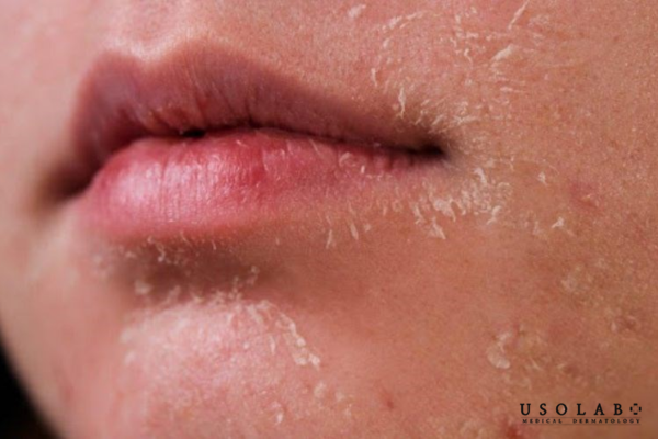 Vì sao da khô mùa đông bôi nhiều kem vẫn không cải thiện Vì sao da khô mùa đông bôi nhiều kem vẫn không cải thiện