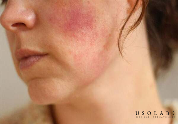 Bong tróc do dị ứng hoặc kích ứng