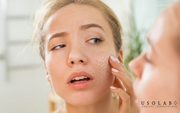 Dấu hiệu đi kèm khi da mặt bị bong tróc