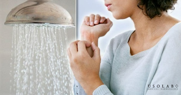 Tránh tắm nước quá nóng, gãi mạnh