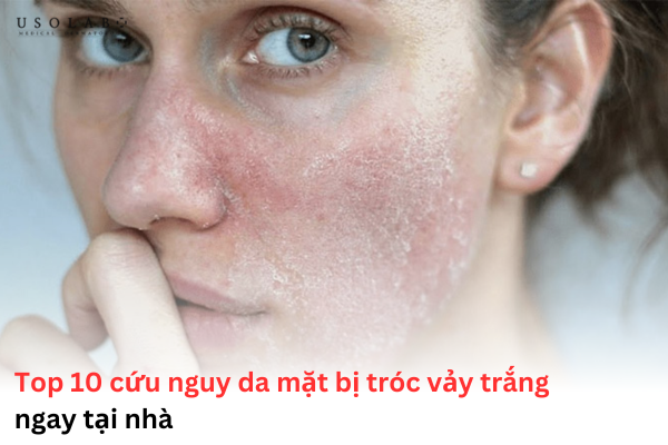da mặt bị tróc vảy trắng